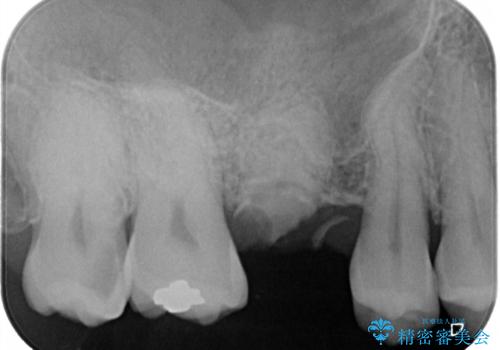放置していたむし歯　抜歯即時埋入インプラントで負担を軽減の治療前