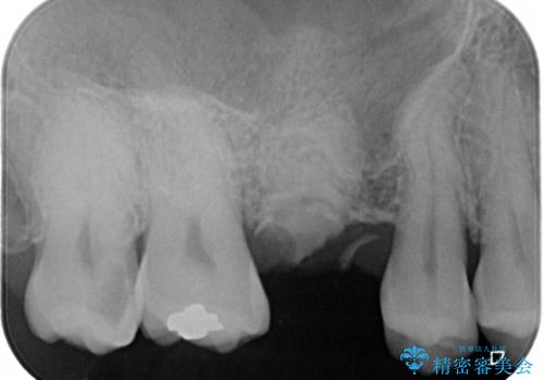 放置していたむし歯 抜歯即時埋入インプラントで負担を軽減の治療前