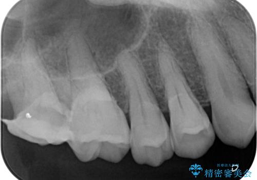 食事をすると痛む奥歯　オールセラミッククラウンでのむし歯治療の治療前