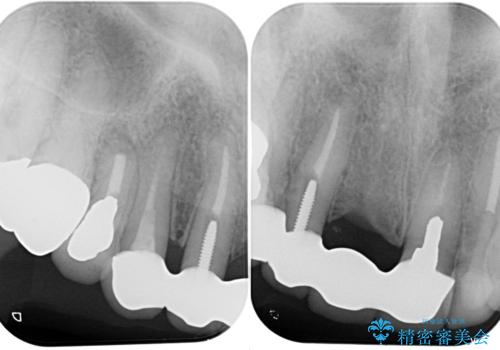 割れてしまった歯と深いむし歯 部分矯正と外科処置で安定したブリッジ治療の治療後