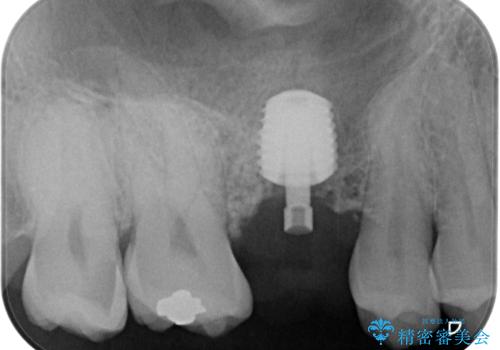 放置していたむし歯　抜歯即時埋入インプラントで負担を軽減の治療中