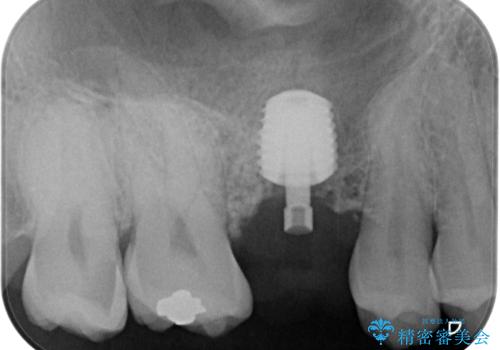 放置していたむし歯 抜歯即時埋入インプラントで負担を軽減の治療中