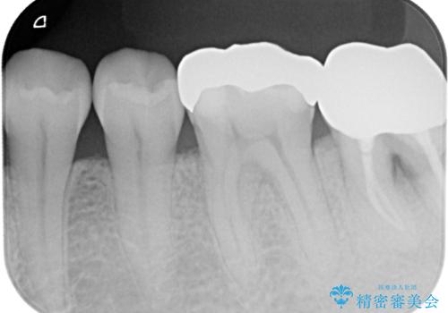外れてしまった奥の銀歯　オールセラミッククラウンによる補綴治療の治療前