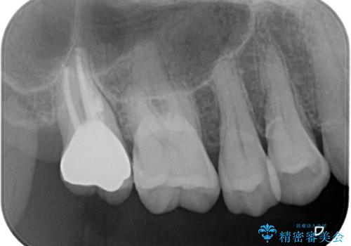 食事をすると痛む奥歯 オールセラミッククラウンでのむし歯治療の治療後
