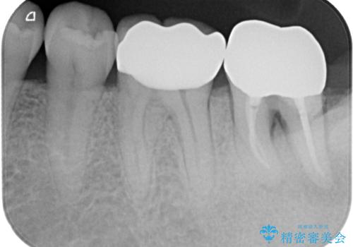 外れてしまった奥の銀歯　オールセラミッククラウンによる補綴治療の治療後