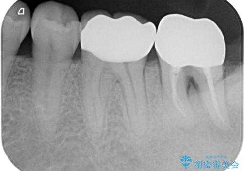 外れてしまった奥の銀歯 オールセラミッククラウンによる補綴治療の治療後