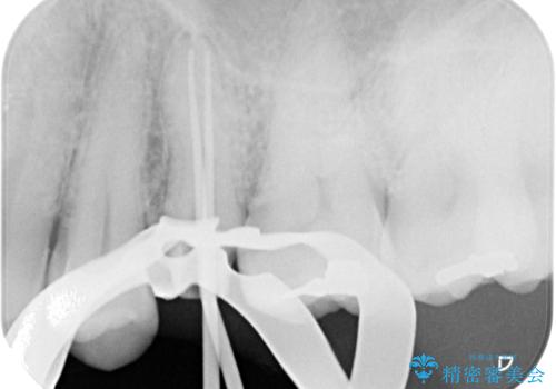 放置していたむし歯　抜歯即時埋入インプラントで負担を軽減の治療中