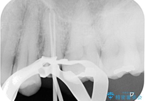 放置していたむし歯 抜歯即時埋入インプラントで負担を軽減の治療中