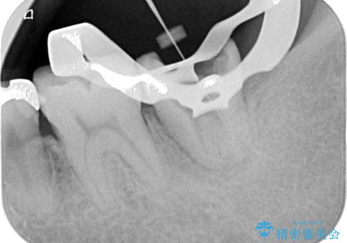 伸び出してきた上顎奥歯 部分矯正を用いた奥歯の補綴治療の治療中