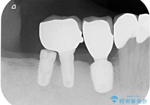 強い咬合力で歯が割れる 1DAYインプラントで歯を守りながら治療の治療後