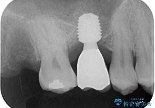 放置していたむし歯　抜歯即時埋入インプラントで負担を軽減の治療後