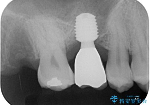 放置していたむし歯 抜歯即時埋入インプラントで負担を軽減の治療後
