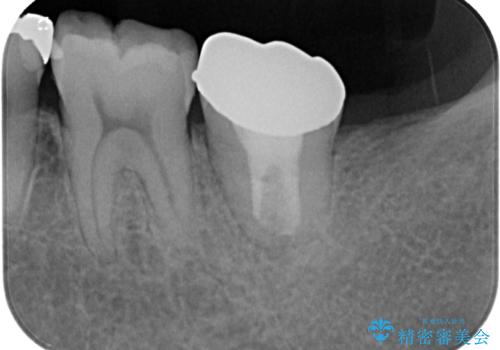 伸び出してきた上顎奥歯 部分矯正を用いた奥歯の補綴治療の治療後