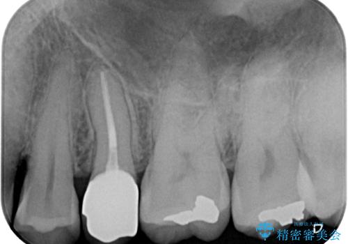 放置していたむし歯　抜歯即時埋入インプラントで負担を軽減の治療後