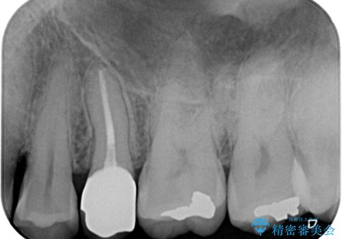 放置していたむし歯 抜歯即時埋入インプラントで負担を軽減の治療後