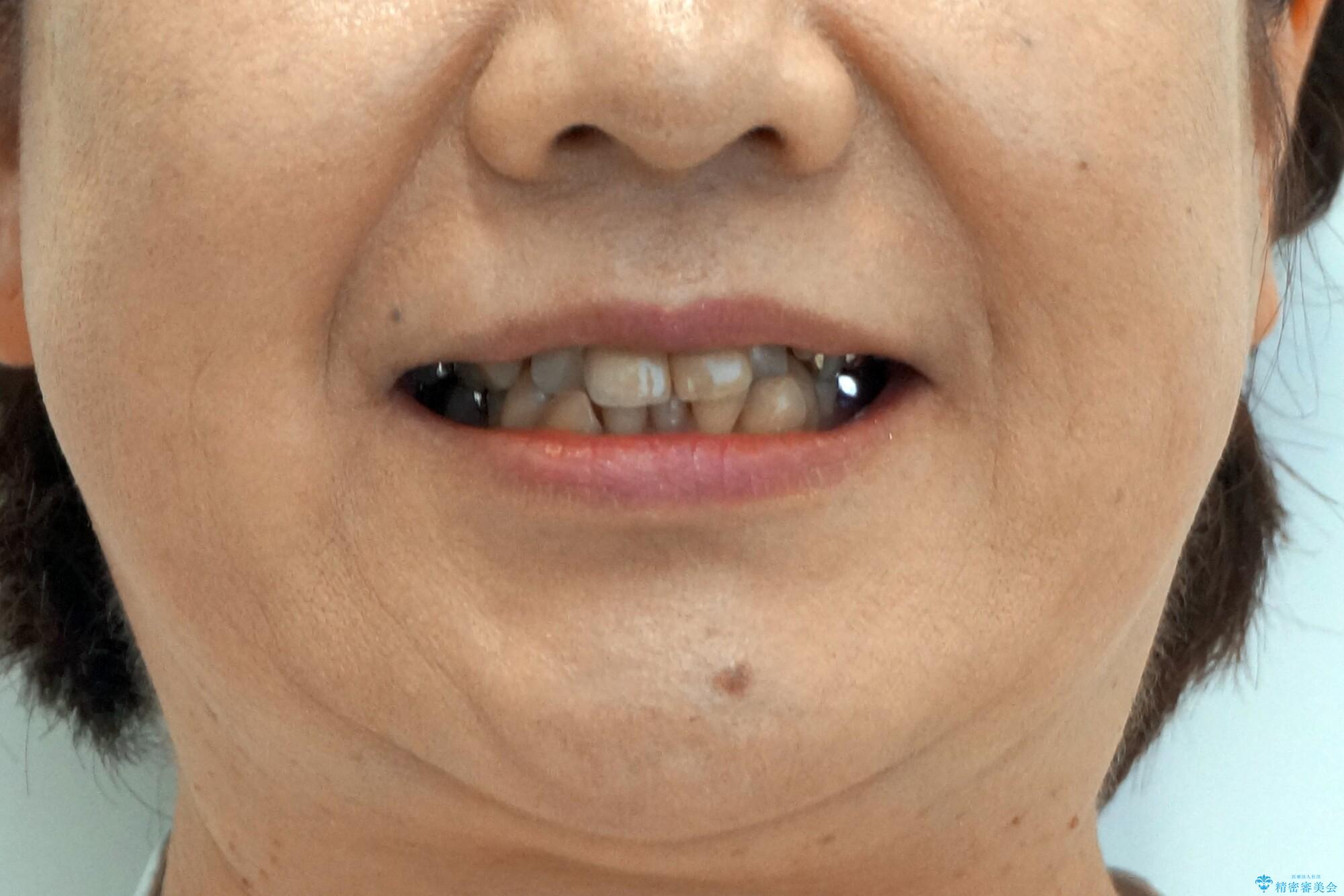 50代女性 八重歯を矯正治療 歯並びの中等度のがたつきの治療前(顔貌)