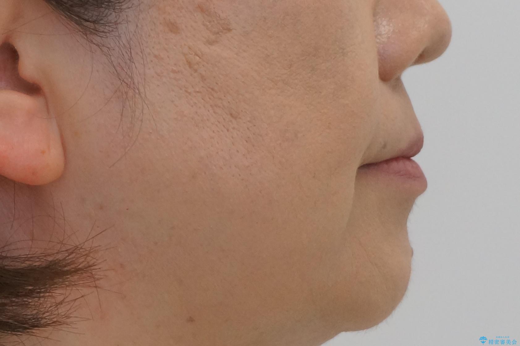 50代女性 八重歯を矯正治療 歯並びの中等度のがたつきの治療前(顔貌)