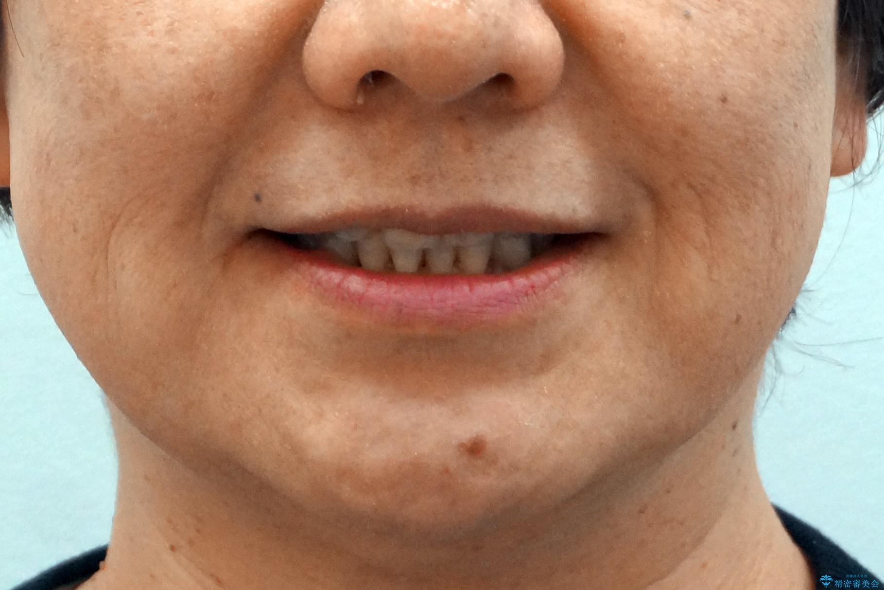 50代女性 八重歯を矯正治療 歯並びの中等度のがたつきの治療後(顔貌)