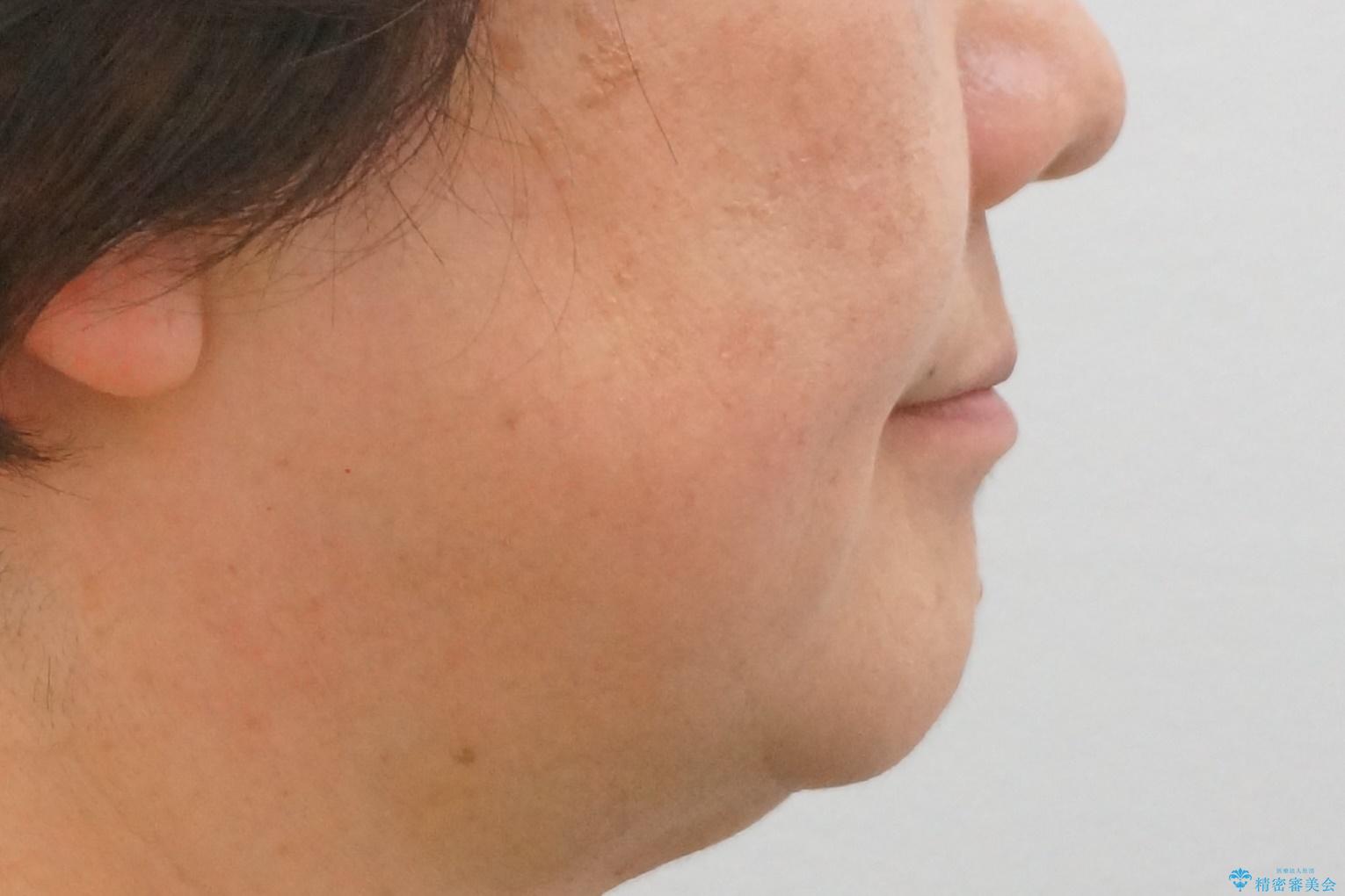 50代女性 八重歯を矯正治療 歯並びの中等度のがたつきの治療後(顔貌)