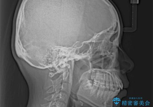 口元の突出感を治したい ワイヤー装置を用いた抜歯矯正の治療前