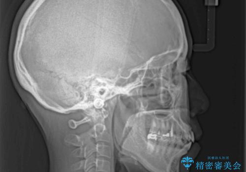 抜歯矯正 ワイヤー装置で横顔の印象を改善の治療前