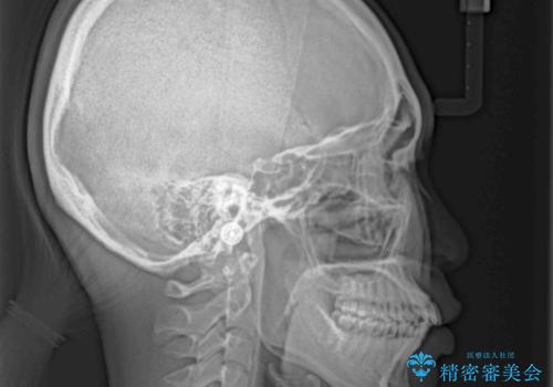 口元の突出感を改善したい。審美装置による抜歯矯正の治療前