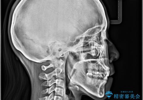 抜歯矯正 ワイヤー装置で横顔の印象を改善の治療後