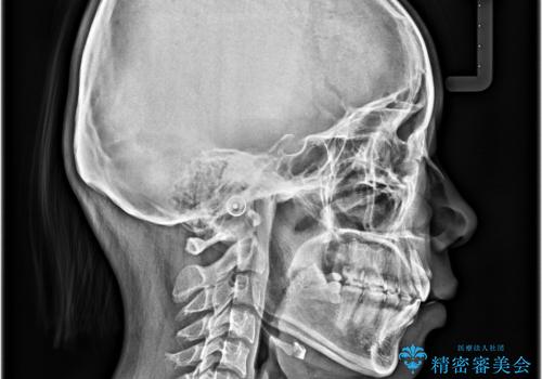 口元の突出感を治したい ワイヤー装置を用いた抜歯矯正の治療後