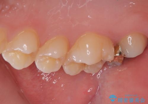 はじめて虫歯ができた ゴールドインレー修復の治療後