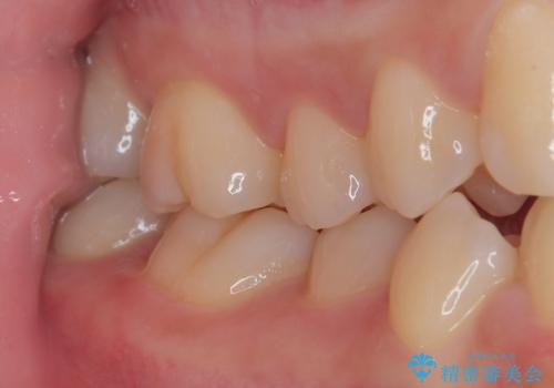 はじめて虫歯ができた ゴールドインレー修復の治療後