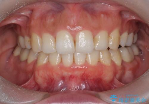 オフィスホワイトニングで歯のトーンを上げるの症例 治療前