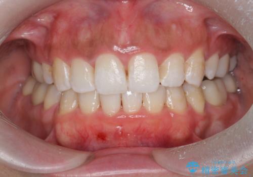 オフィスホワイトニングで歯のトーンを上げる