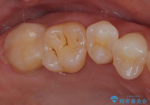 食事をすると痛む奥歯　オールセラミッククラウンでのむし歯治療の治療前