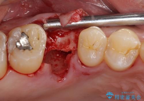 放置していたむし歯　抜歯即時埋入インプラントで負担を軽減の治療前