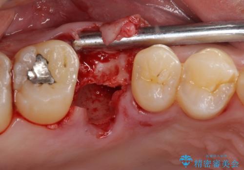 放置していたむし歯 抜歯即時埋入インプラントで負担を軽減の治療前