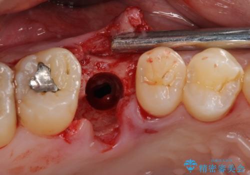 放置していたむし歯　抜歯即時埋入インプラントで負担を軽減の治療中