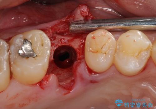 放置していたむし歯 抜歯即時埋入インプラントで負担を軽減の治療中