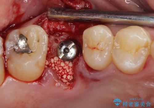 放置していたむし歯　抜歯即時埋入インプラントで負担を軽減の治療中