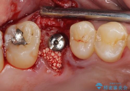 放置していたむし歯 抜歯即時埋入インプラントで負担を軽減の治療中