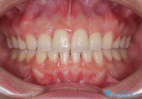 口元の突出感を改善したい。審美装置による抜歯矯正の症例 治療後