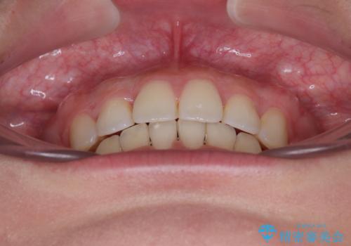 口元の突出感を改善したい。審美装置による抜歯矯正の治療後