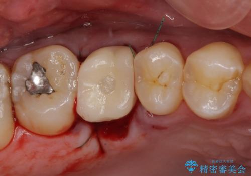 放置していたむし歯　抜歯即時埋入インプラントで負担を軽減の治療後