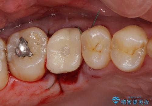 放置していたむし歯 抜歯即時埋入インプラントで負担を軽減の治療後