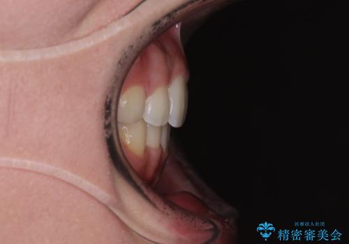 口元の突出感を改善したい。審美装置による抜歯矯正の治療後