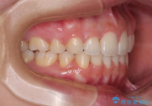 口元の突出感を改善したい。審美装置による抜歯矯正の治療後