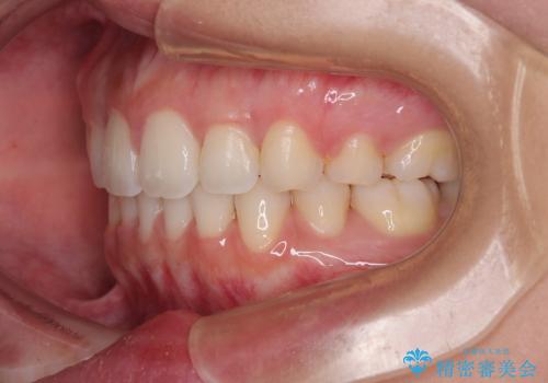 口元の突出感を改善したい。審美装置による抜歯矯正の治療後