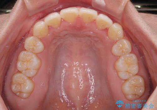 口元の突出感を改善したい。審美装置による抜歯矯正の治療後