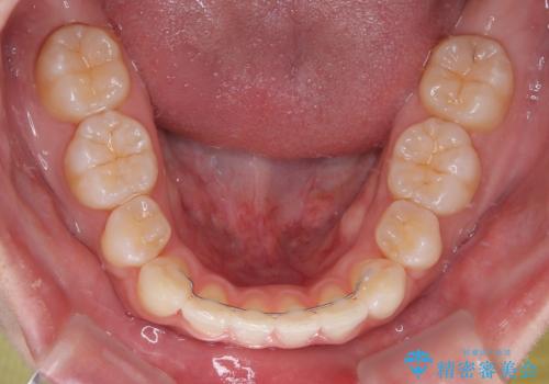 口元の突出感を改善したい。審美装置による抜歯矯正の治療後