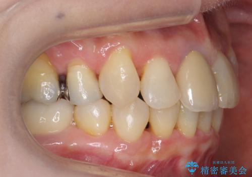 50代女性 八重歯を矯正治療 歯並びの中等度のがたつきの治療後