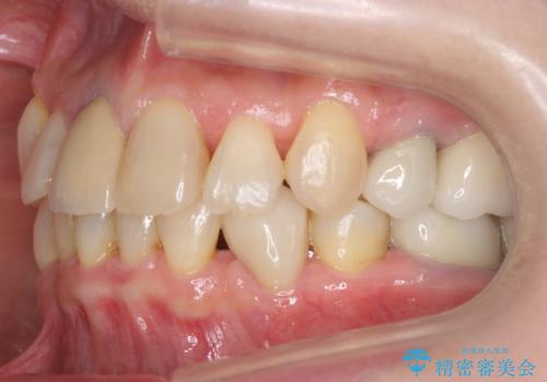 50代女性 八重歯を矯正治療 歯並びの中等度のがたつきの治療後